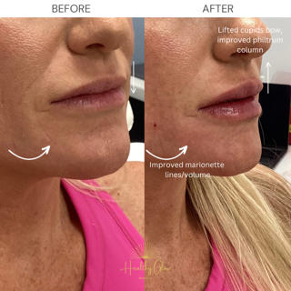 Before & After Treatment Image | Healthy Glow Medical in Orlando, FL