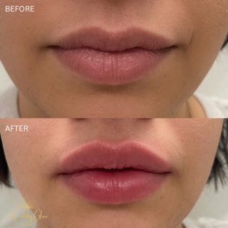 Before & After Lips Treatment Image | Healthy Glow Medical in Orlando, FL