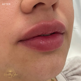After Lips Treatment Image | Healthy Glow Medical in Orlando, FL