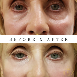 Woman face, eye wrinkles before and after treatment - the result of rejuvenating cosmetological procedures of biorevitalization, botox and pigment spots removal | Healthy Glow Medical in Orlando, FL