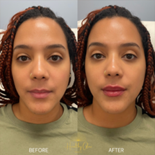 Young Girls face, eye wrinkles before and after treatment - the result of rejuvenating cosmetological procedures of biorevitalization, botox and pigment spots removal | Healthy Glow Medical in Orlando, FL