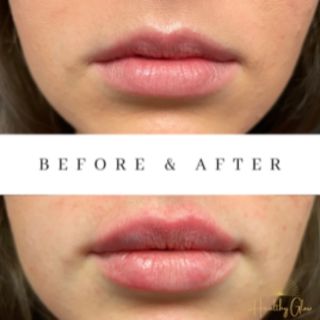 Before and After Lips filler injection for beautiful woman lip augmentation with hyaluronic acid at a beauty salon | Healthy Glow Medical in Orlando, FL