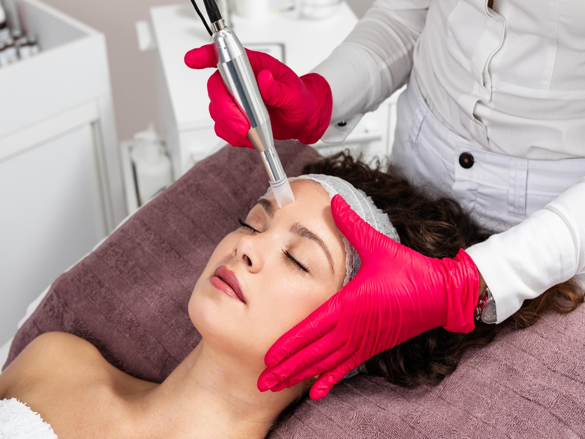 Is Microneedling Better Than Chemical Peels?